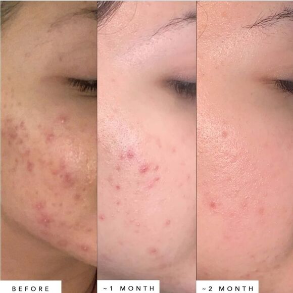 Herbivore Lapis Blue Tansy Facial Oil For Irritated Or Blemish Prone Skin - Picture 4 of 12